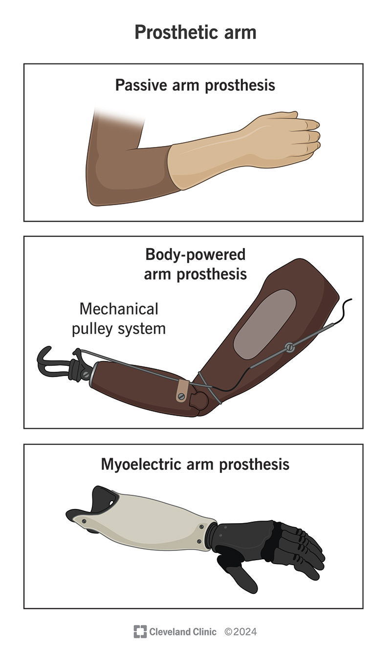 Prosthetic Arm: What it is? Who Needs It & How It’s Used